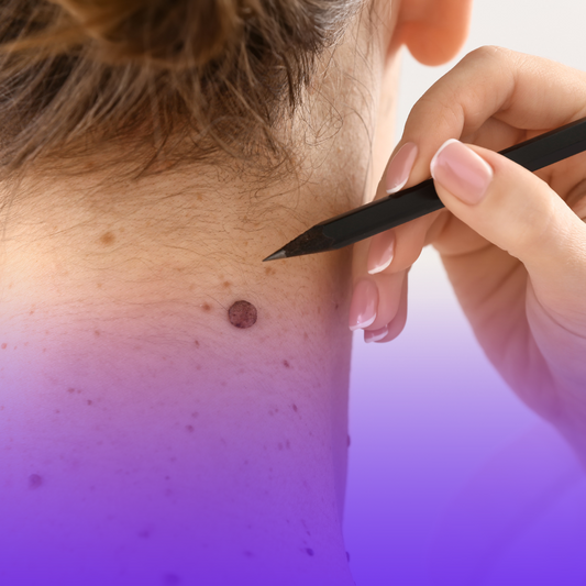 Skin Tag Removal