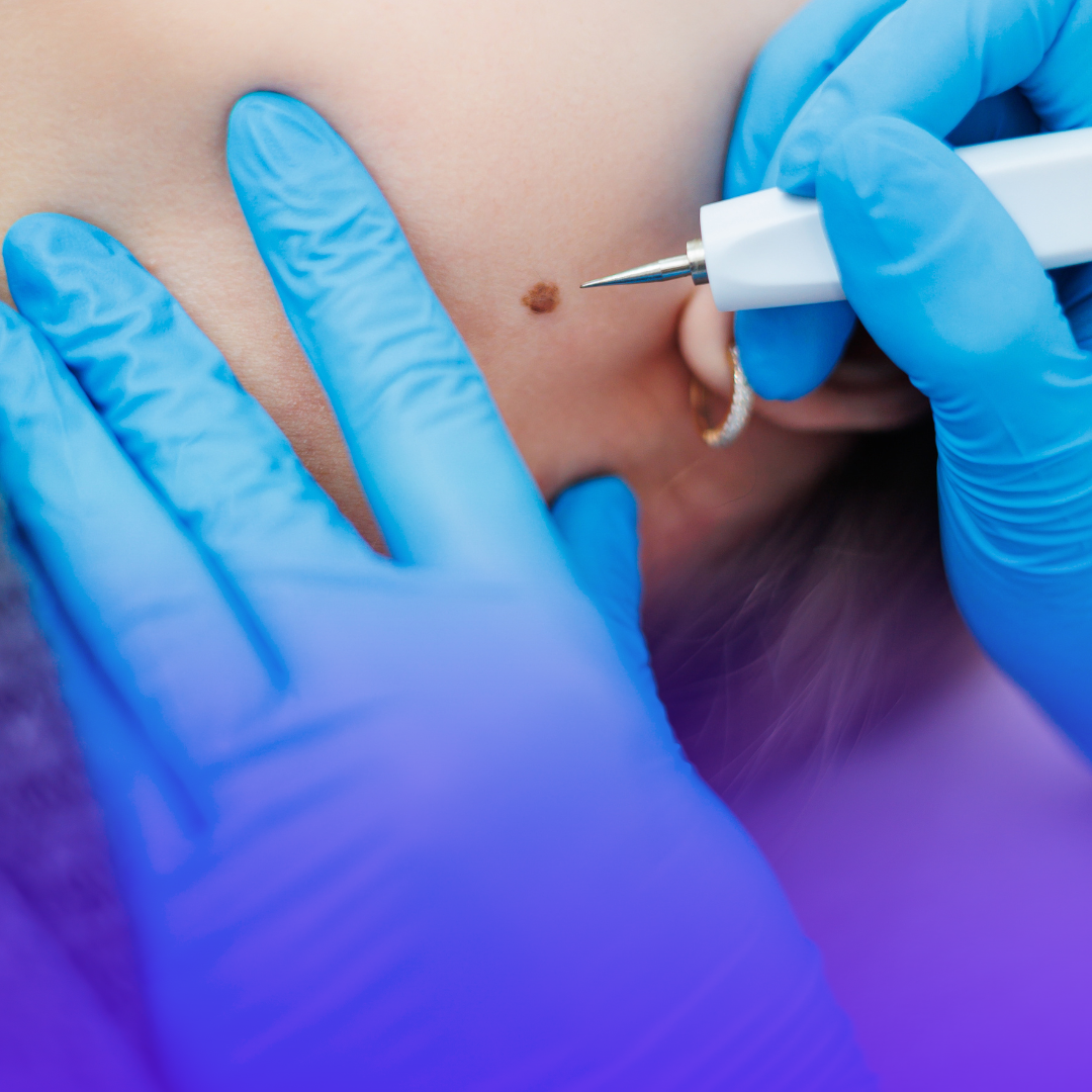 Skin Tag Removal